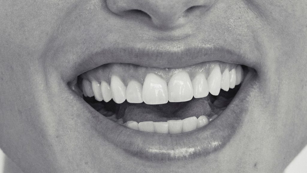 Carillas dentales: ventajas, desventajas, precios y todo lo que nunca te atreviste a preguntar