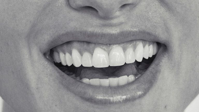 Carillas dentales: ventajas, desventajas, precios y todo lo que nunca te atreviste a preguntar