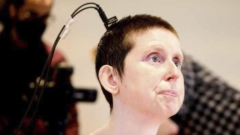 Una mujer vuelve a hablar 18 años después de un ictus gracias a una neuroprótesis